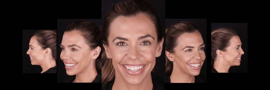 Smile Makeover