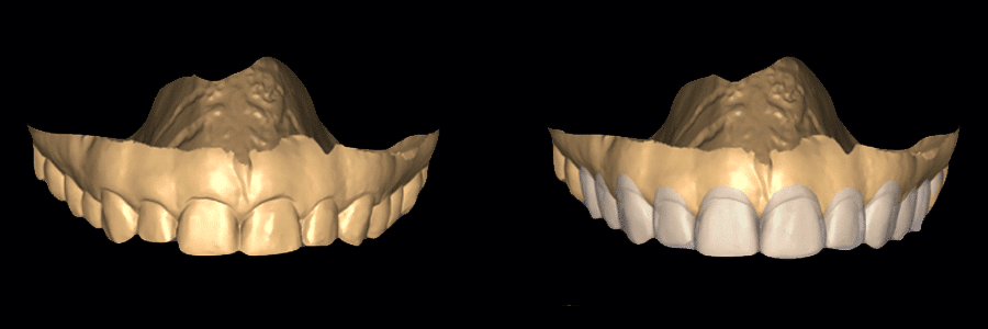 Smile Makeover