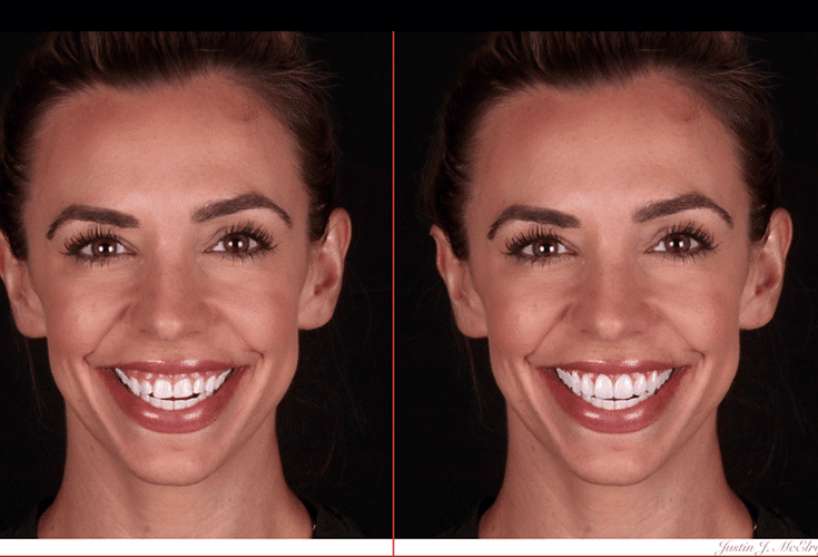 Smile Makeover