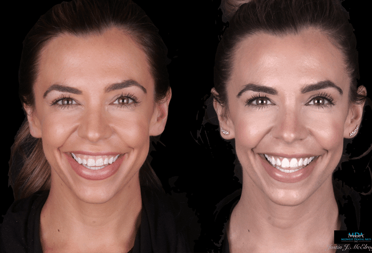 Smile Makeover