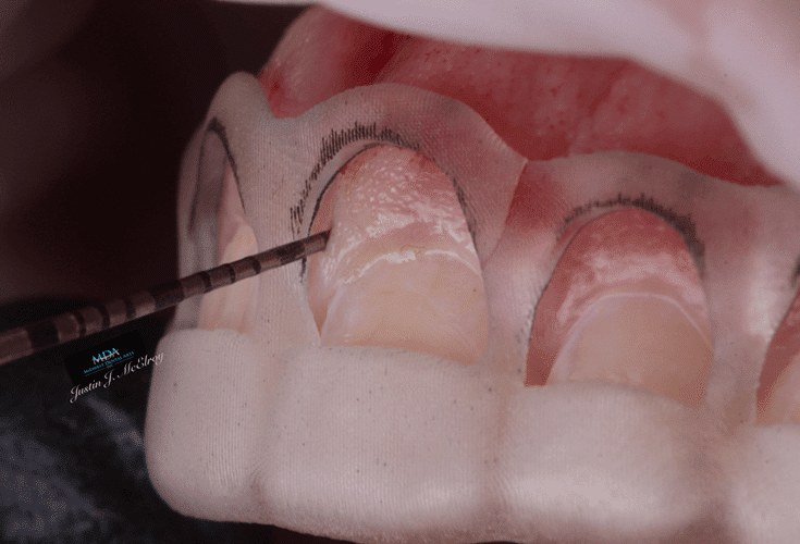 Smile Makeover
