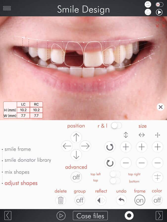 Smile Makeover